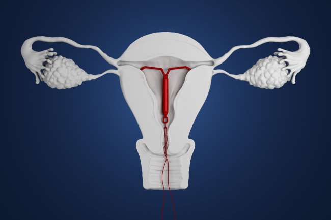 IUD Insertion